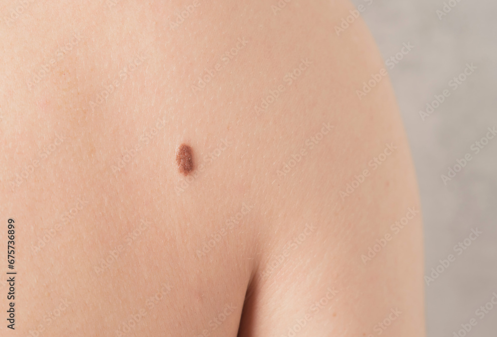 Close-up of a mole on a person's back. Skin Cancer Awareness Month Close-up of a mole on a person's back. Skin Cancer Awareness Month
