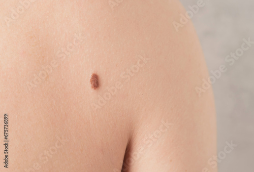 Close-up of a mole on a person's back. Skin Cancer Awareness Month photo
