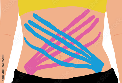 Lymphatic drainage kinesiotape for the abdomen. Weight loss with taping. Vector illustration isolated on the white background