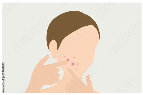 Young woman face with skin acne, pimples, blackheads vector illustration. Acne skin face problem concept