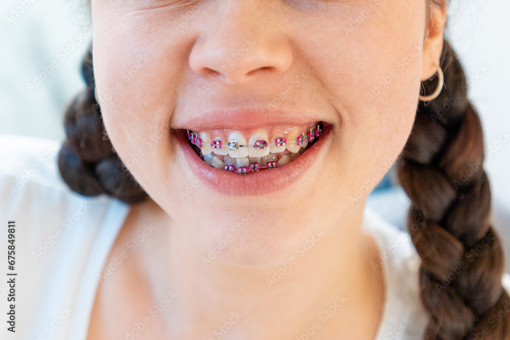 Fototapeta premium Close-up of smiling young woman with braces on white teeth. Concept of orthodontic, dental care and malocclusion