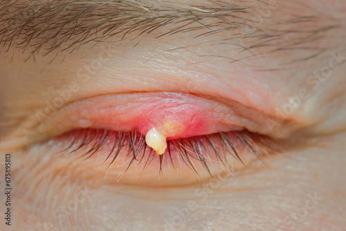 Burst abscess with pus on eyelid. Eye diseas with swollen, inflamed eyelid. Chalazion on upper eyelid close up. Chalazion on eyelid. Demodicosis mite disease, demodex. Selective focus photo