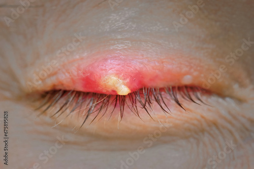 Burst abscess with pus on eyelid. Eye diseas with swollen, inflamed eyelid. Chalazion on upper eyelid close up. Chalazion on eyelid. Demodicosis mite disease, demodex. Selective focus photo