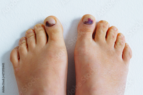 Tired female feet barefoot with bruise on big toe from tight uncomfortable shoes photo