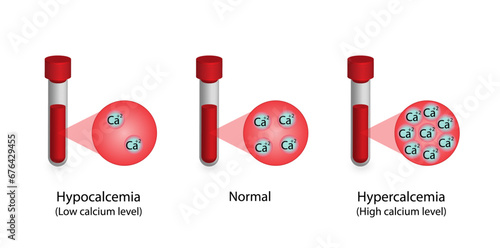 Hypercalcemia, high plasma calcium level and hypocalcemia, low plasma calcium level. Calcium excess and deficit electrolyte disorders, blood droplet, Scientific design. Vector illustration.