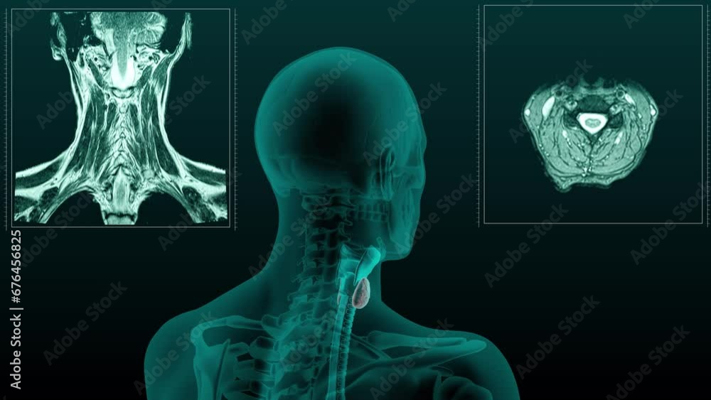 MRI xray scan of the thyroid gland in different projections on a dark