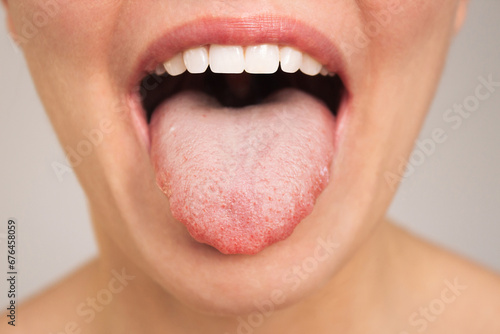 Caucasian woman opens her mouth and shows a sick tongue with teeth marks and a white plaque close-up. Endocrinology. Gastrointestinal diseases photo