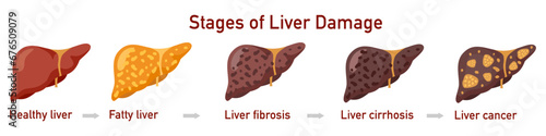 Set of flat vector illustrations on the theme of medicine. Stages of liver diseases. . Vector illustration