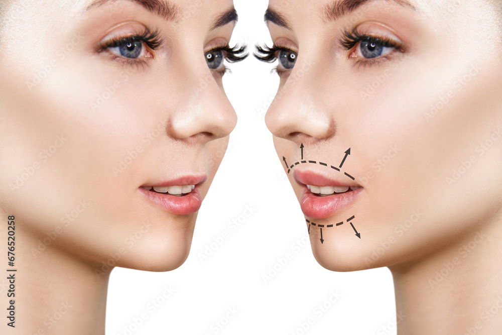 Woman lips before and after lip filler injections. Woman lips before and after lip filler injections.