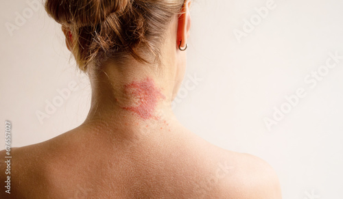 Manifestation of atopic dermatitis as a red itchy spot on a woman’s neck, close-up, rear view, copy space. Dermatology, allergy, itching, red spot or rash on skin