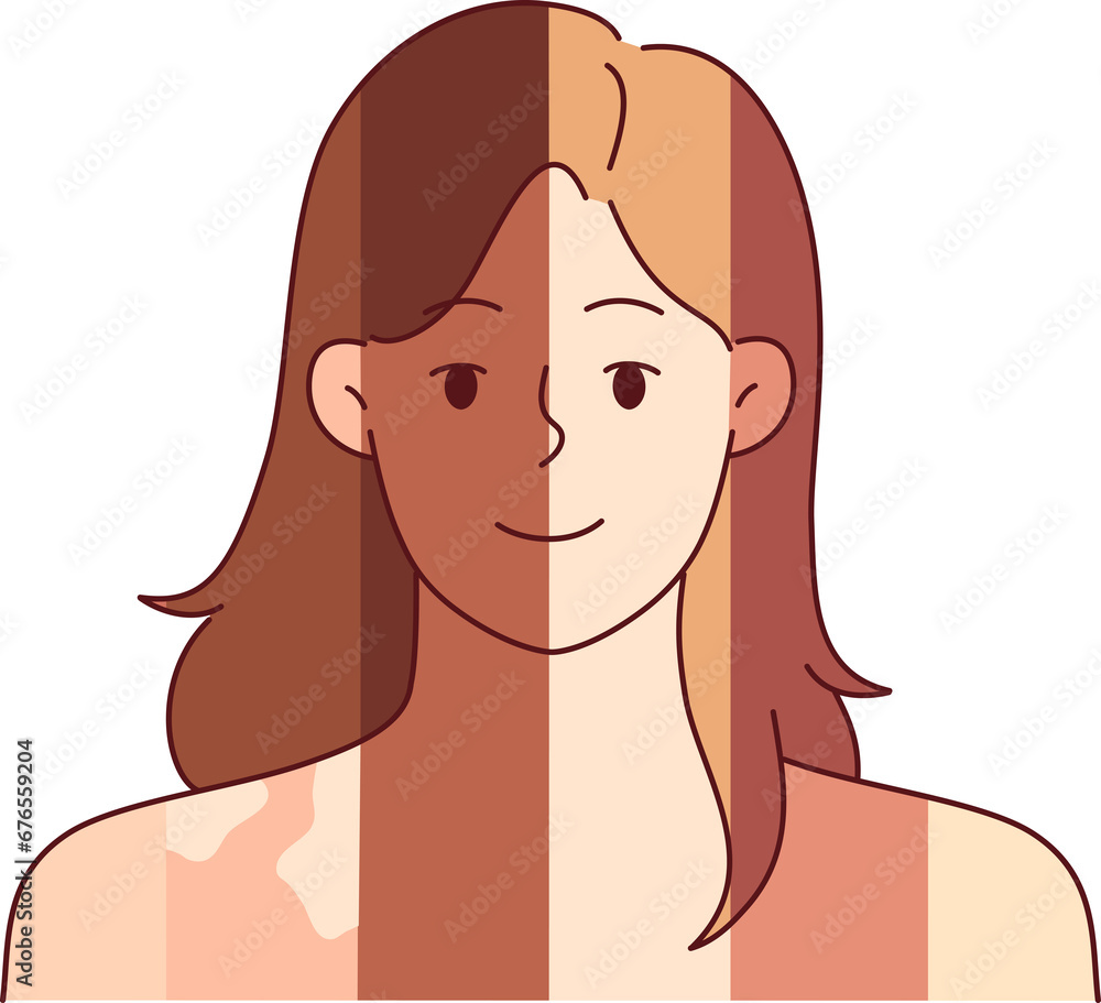 Woman with different skin colors and vitiligo spots on body symbolizes difference between people Woman with different skin colors and vitiligo spots on body symbolizes difference between people