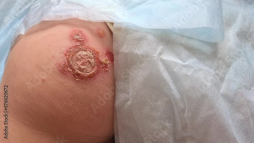 Large amount of red rash on child back and butt. Rash and pus and herpes on child buttocks photo