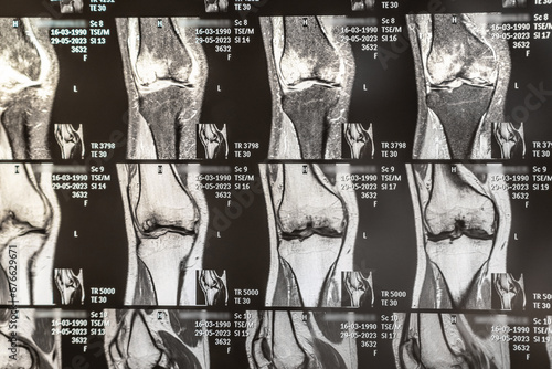 Knee joint x-ray or MRI. Doctor pointed on area of knee joint, where pathology or problem is detected, such fracture, destruction of joint, osteoarthritis. photo