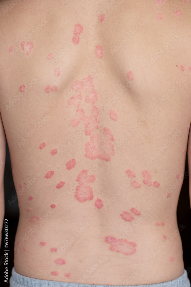 Psoriasis Vulgaris, skin patches are typically red, itchy, and scaly. Papules of chronic psoriasis vulgaris on male hand, back and body. Genetic immune disease. Detail of psoriatic skin disease Psoriasis Vulgaris, skin patches are typically red, itchy, and scaly. Papules of chronic psoriasis vulgaris on male hand, back and body. Genetic immune disease. Detail of psoriatic skin disease
