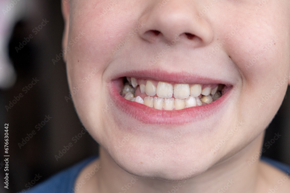 Child's crooked teeth. Young man showing crooked growing teeth. The ...