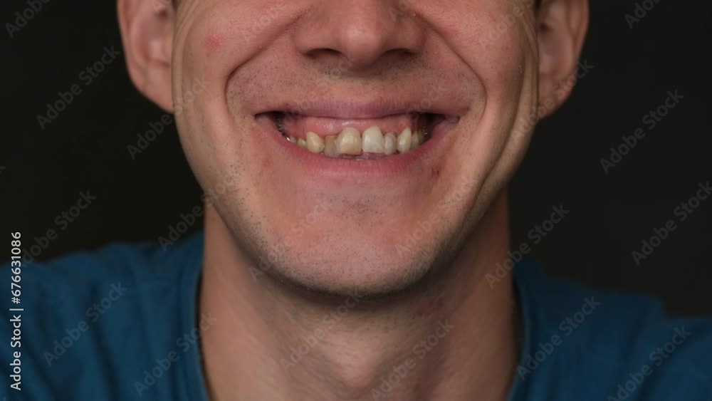 A man's crooked teeth. Young man showing crooked growing teeth. The man needs to go to the dentist to install braces.