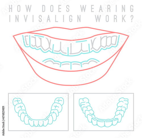 Orthodontic silicone trainer. Medical banner in outline style.