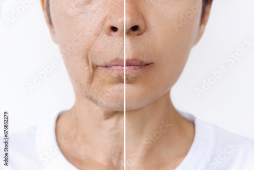 Lower part of face and neck of elderly woman with signs of skin aging before after plastic surgery. Age-related changes, flabby sagging skin, wrinkles, creases, puffiness. Rejuvenation, facelift photo