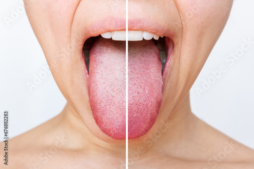Female tongue with a white plaque. Comparison of a diseased tongue with a white plaque and a healthy clean tongue before and after treatment on a light background. The result of cleaning the tongue photo