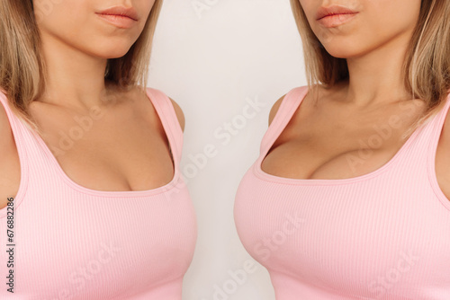 Young woman in pink top before and after breast augmentation with silicone implants. The result of a breast lifting. Breast size correction isolated on a light background. Plastic surgery concept photo