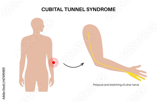 Cubital tunnel syndrome