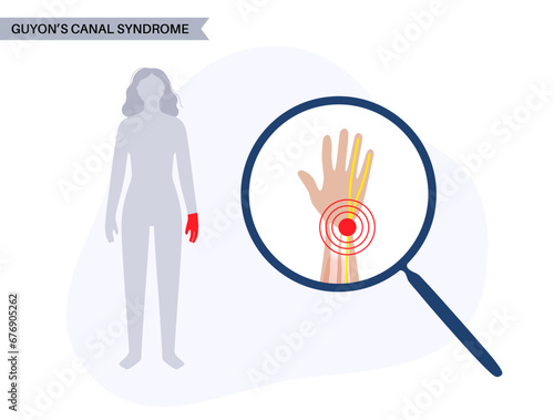 Guyons canal syndrome