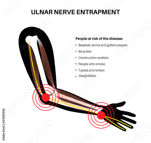 Ulnar nerve entrapment photo