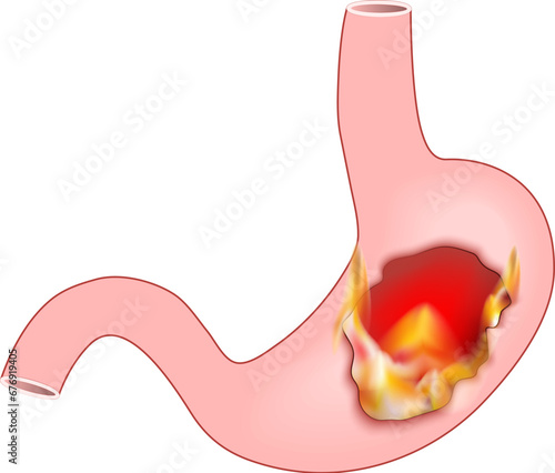 Heartburn. Human stomach with flame.