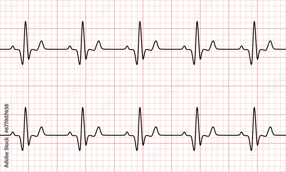 Normal sinus rhythm from Electrocardiogram(EKG) heart graph. Vital Sign. Vector Medical Illustration.