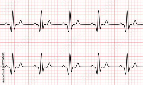 Normal sinus rhythm from Electrocardiogram(EKG) heart graph. Vital Sign. Vector Medical Illustration.