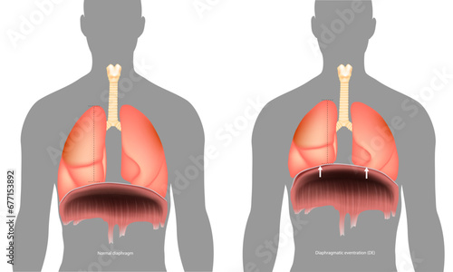 Normal diaphragm or Diaphragmatic eventration. Abnormal elevation of a portion or entire hemidiaphragm. Paralysis of the diaphragm