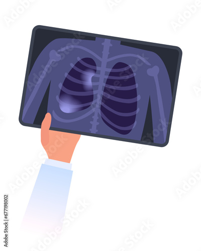 Healthy and collapsed lung x-ray image. Doctor`s hand holds MRI scan of partial closure of a lung. Respiratory failure, Atelectasis or pleurisy disease concept. Chest pain, lungs decrease illustration