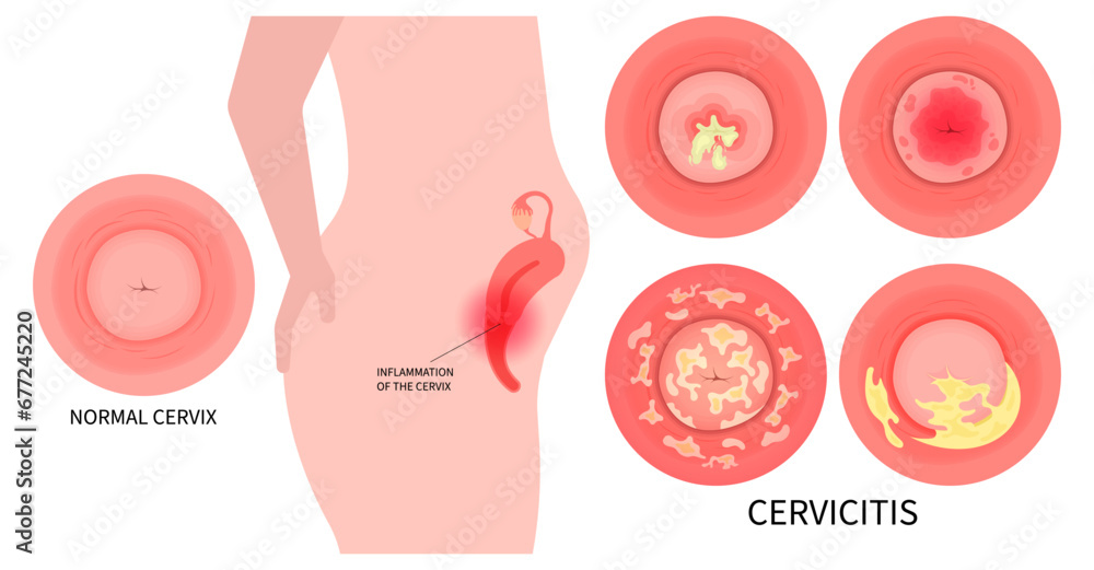 Cervical cancer and Pelvic inflammatory disease after bacteria infection with ovary vagina painful - obrazy, fototapety, plakaty 