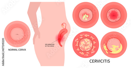 Cervical cancer and Pelvic inflammatory disease after bacteria infection with ovary vagina painful photo