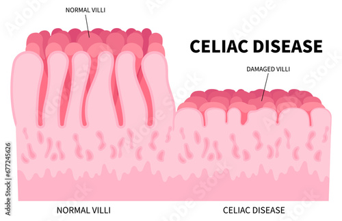 Ulcerative colitis for the small intestinal of Celiac disease with Stomach bacterial and Crohn's disorder that cause pain or fatty stools in medical photo