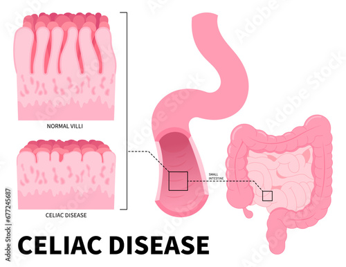 The gastrointestinal infection of Celiac disease with Stomach bacterial and Crohn's disorder that cause small intestinal pain or fatty stools in medical photo