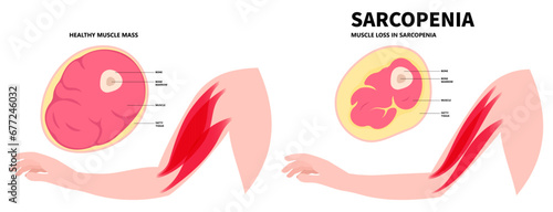 The Sarcopenia disorder that cause arm and leg muscle loss in older adults with body nerve pain injury of limb by low nutrition after aging