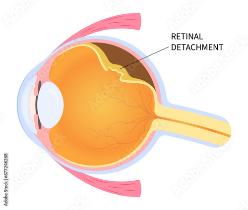 Eye blurred vision loss with floaters Myopia and detached retina after trauma injury of macular hole that tear or torn which lead to pain in nearsighted