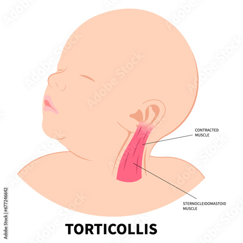 Neck muscle stiffness pain in adults or baby with chronic cervical dystonia disorder and the Torticollis of occupational therapy exercise