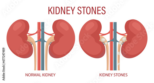 Kidney stones. Human kidney disease. Medical infographic banner, illustration, vector