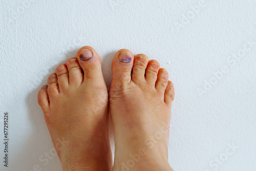 barefoot female feet with bruise on big toe nail due to tight uncomfortable shoes on white background photo
