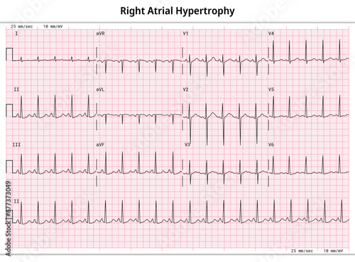 ECG Right Atrial Hypertrophy (RAH) - Right Atrial Enlargement (RAE) - 12 Lead ECG Common Case - 3 Sec per lead - Electrocardiogram Medical Vector Illustration