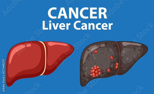 Comparing Liver Cancer: Healthy vs Abnormal Cell Growth