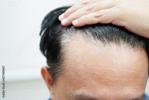Bald head in man, hair loss treatment health problem.