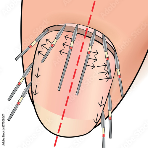 Illustration with hardware manicure technology. Correct position of the cutter in the vector. Educational material