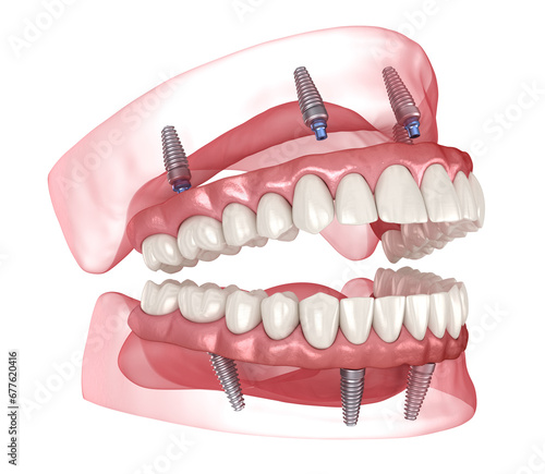 Dental prosthesis based on 4 implants. Dental 3D illustration photo