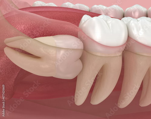 Horizontal impaction of Wisdom tooth. Medically accurate tooth 3D illustration