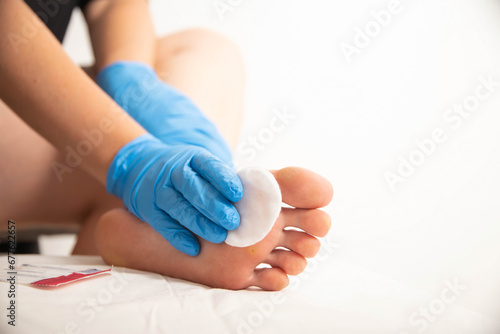 Treatment of a callus on the foot with a special solution after surgery to remove the callus and wart. Copy space for text photo