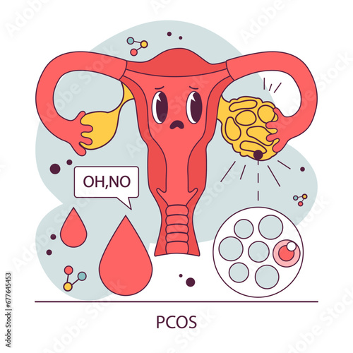 PCOS, polycystic ovary syndrome. Female reproductive system. Endocrine system organ disease. Human hormones secretion imbalance. Flat vector illustration