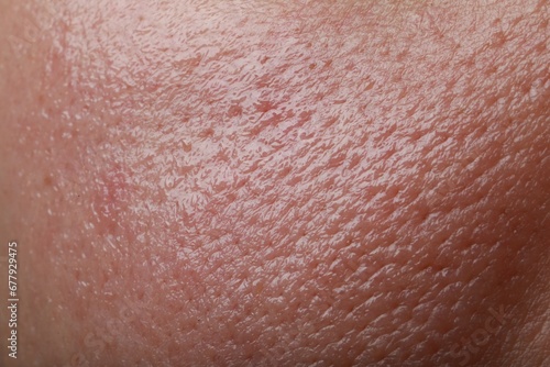 Closeup view of human oily skin as background photo